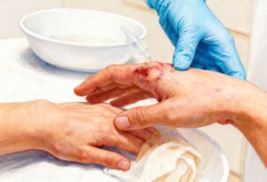 Manejo Avanzado de Heridas Estomas Inscripción